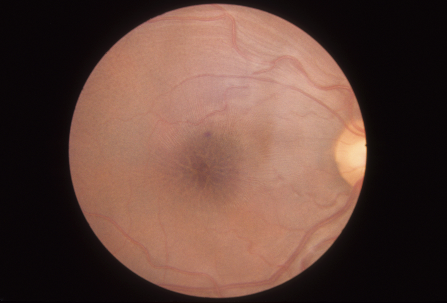 Retinoschisis, Juvenile Hereditary Ocular Diseases